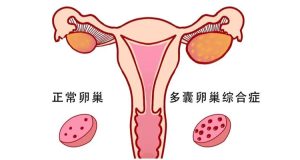 多囊患者備孕失敗多次？深圳排卵監測幫到你